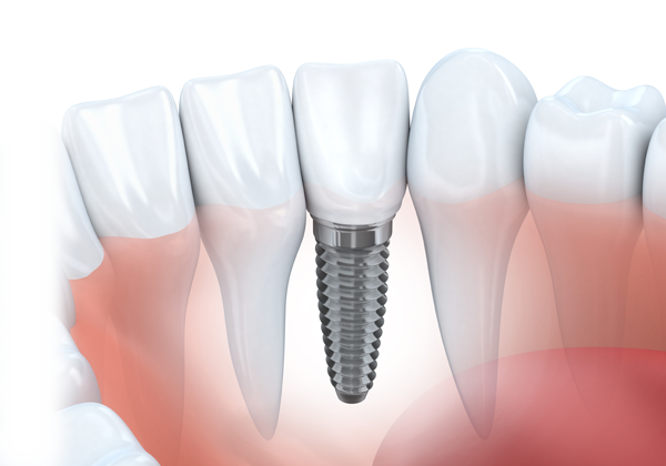 Dental Implant Melbourne