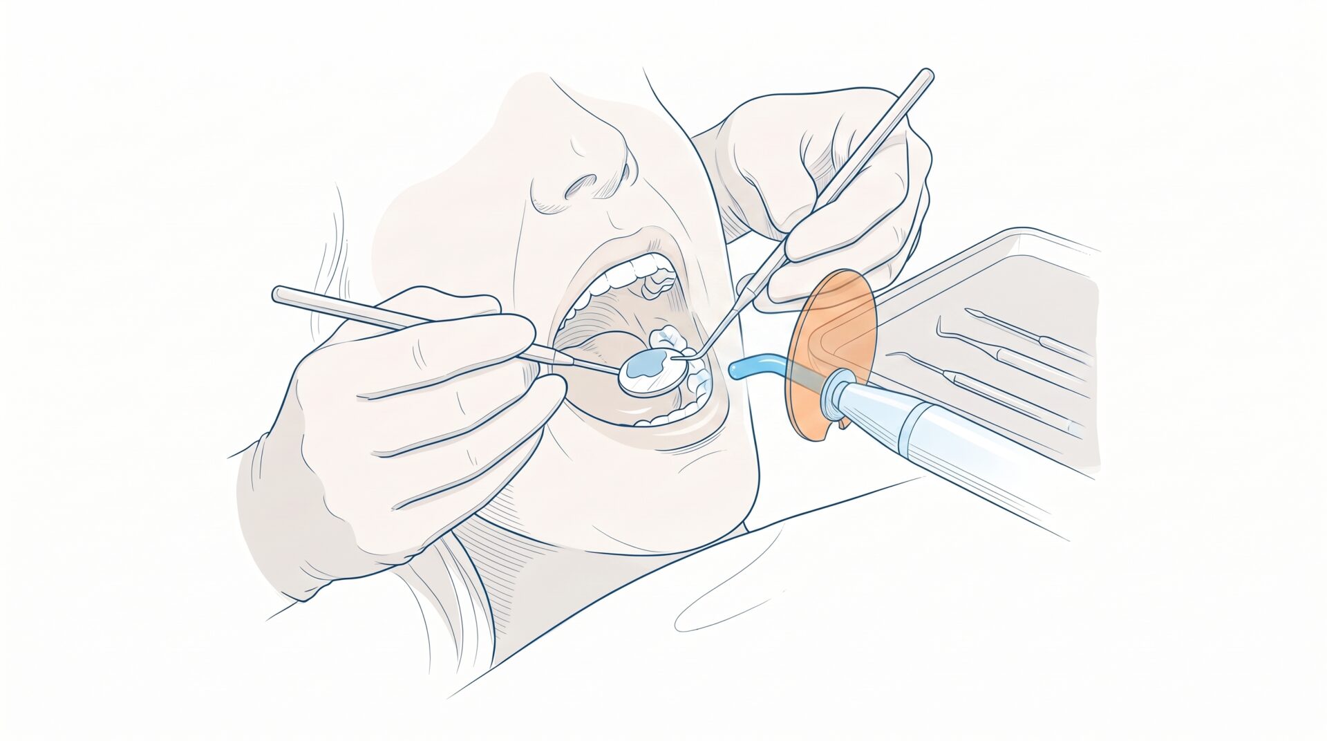 A dental professional places a composite filling in a back tooth during treatment.