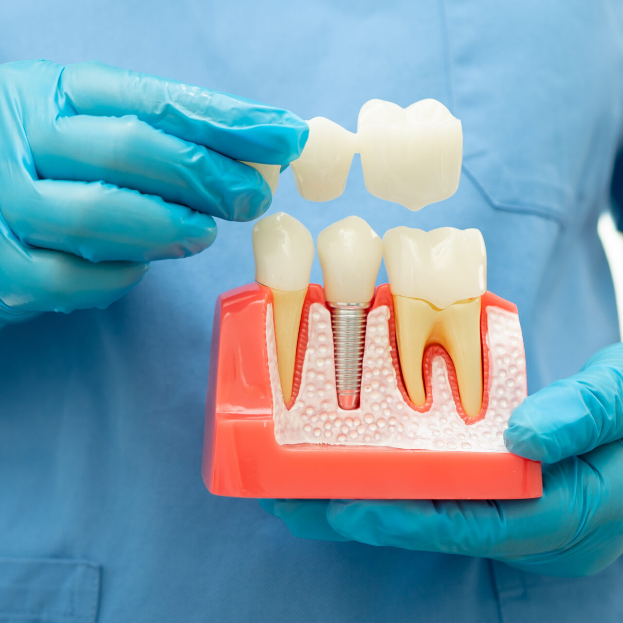Dental Bridge Model