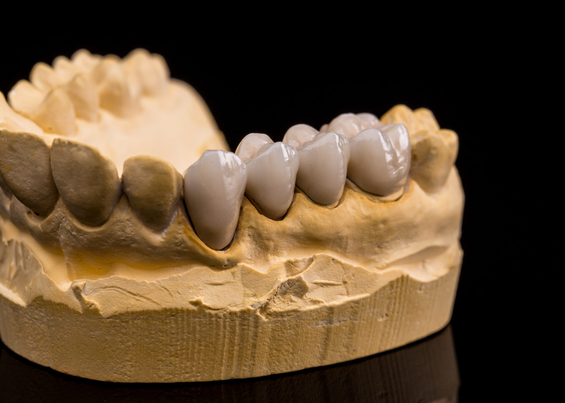 Dental Crowns Image
