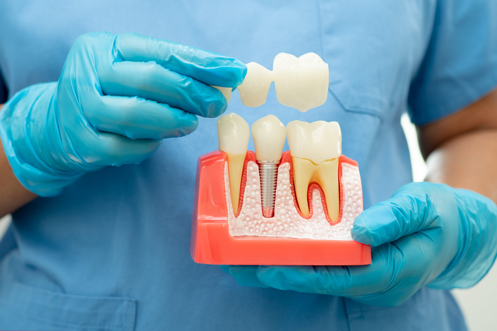 Dental Bridge Model