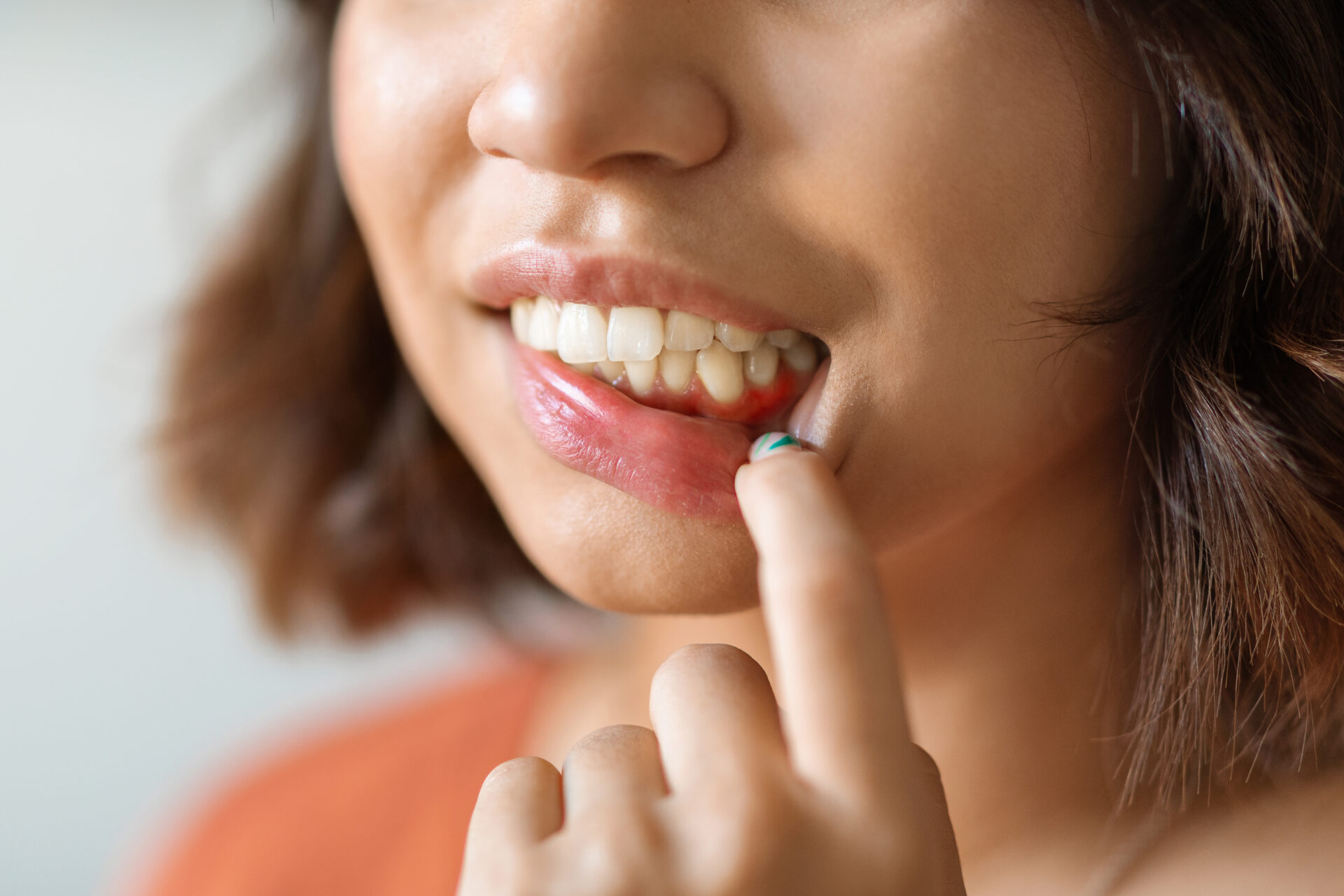 Gum Disease Image