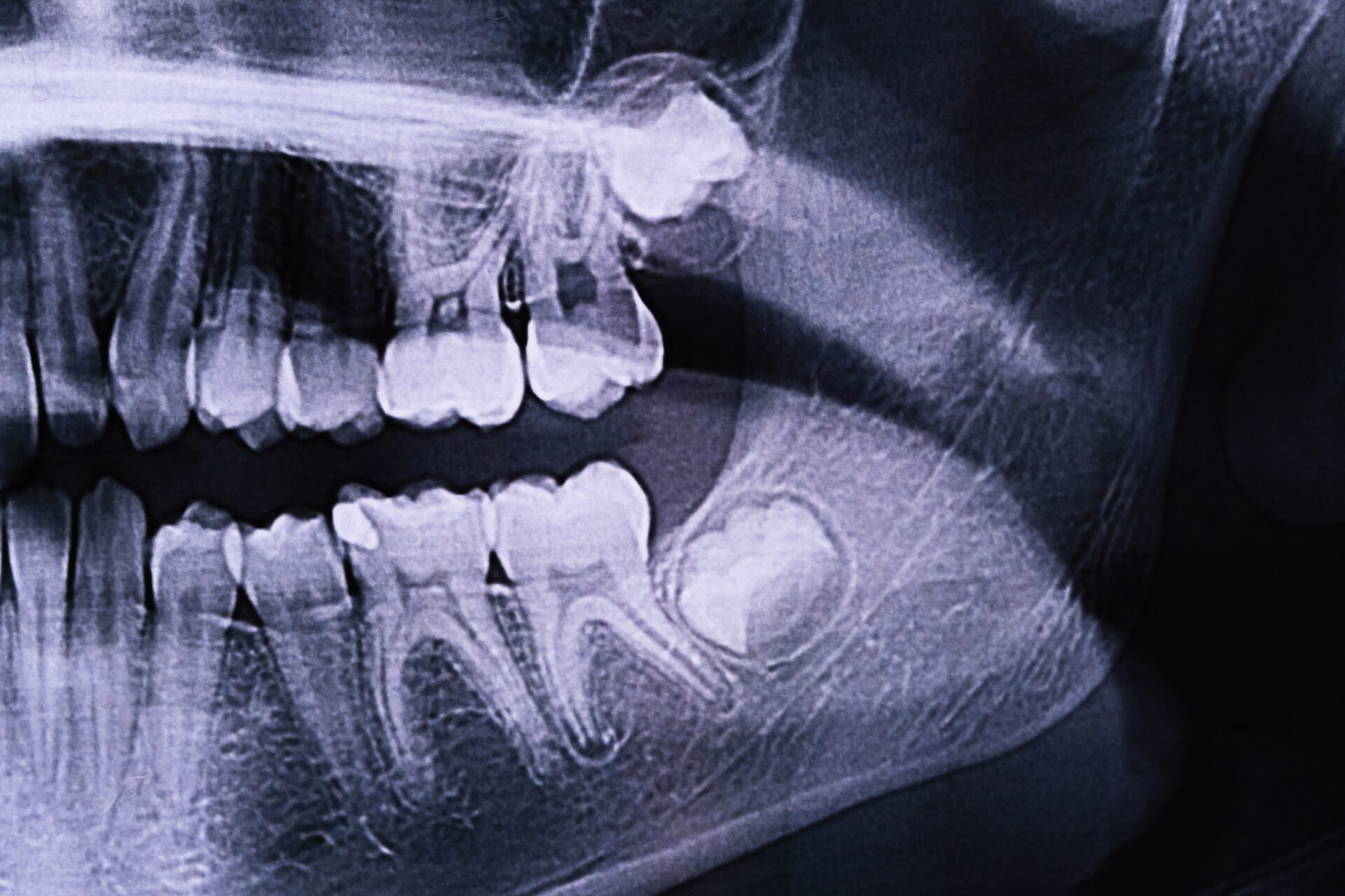 Wisdom Teeth Removal: X-ray of problematic 