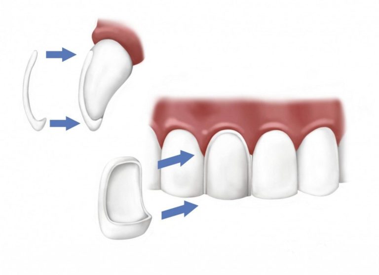 Dental Veneers