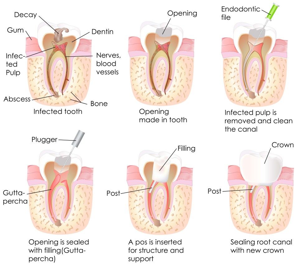 Endodontics (Root Canal) Infographic