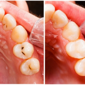 Tooth-Coloured Fillings Patient Image